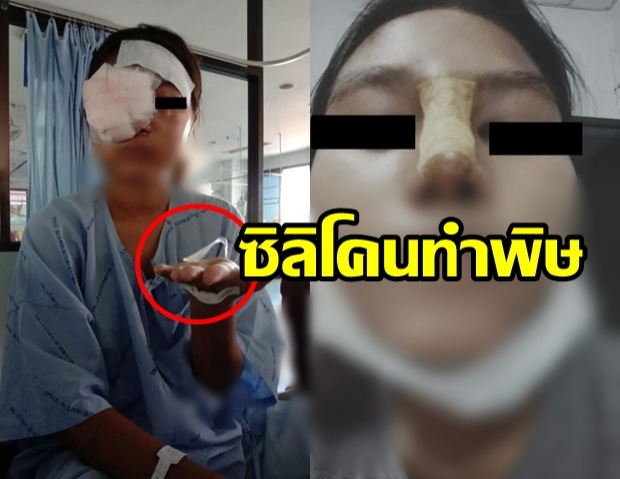 สาวเสริมจมูก ซิลิโคนเน่าติดเชื้อรุนแรง ‘ตา-หน้าบวม’ ต้องผ่าตัดด่วน..คลิป