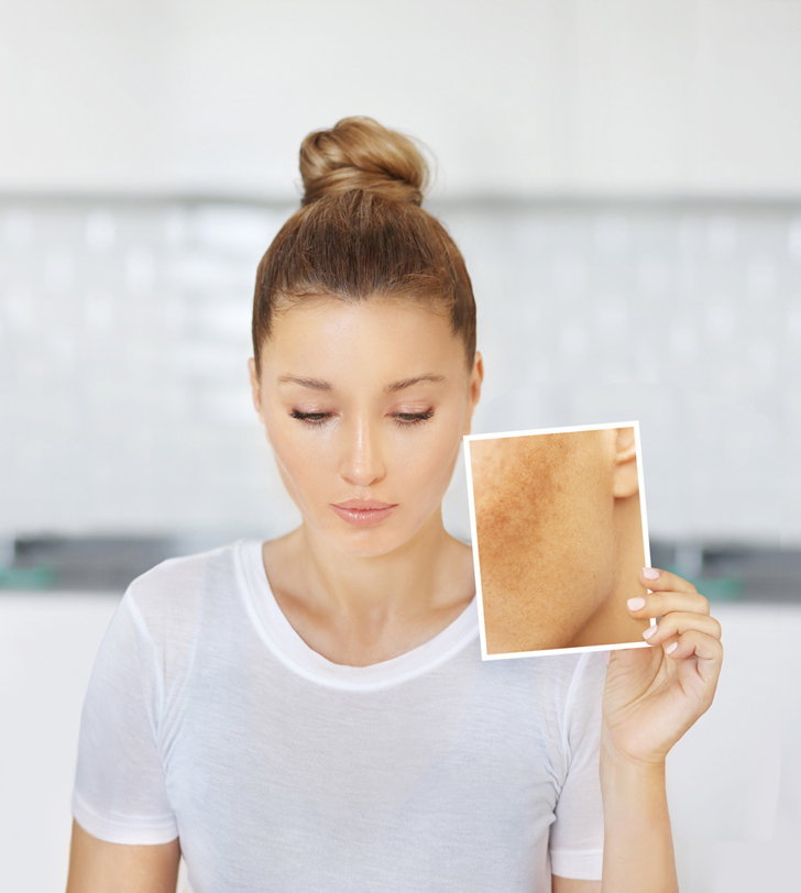 5  วิธีทำรักษาฝ้า ให้หน้าขาวฉ่ำเด้งง่ายๆ  เปลี่ยนหน้าหมองให้เป็นหน้าใส