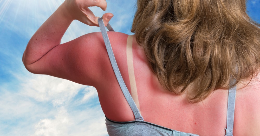 7 วิธีง่ายๆ รักษาผิวไหม้จากแดดให้ดูเรียบเนียนขาวใสได้ สารสกัดจากธรรมชาติเท่านั้น โดยไม่ต้องพึ่งสารเคมีใดๆเลยก็ว่าได้